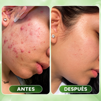 Lineva Azelaico Brotes Rojeces Marcas