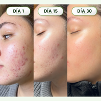 Lineva Azelaico Brotes Rojeces Marcas